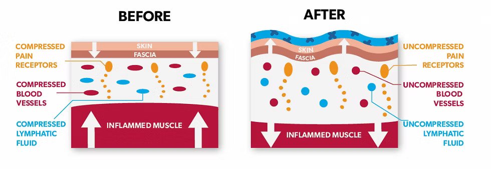 How Does Kinesio Tape Work