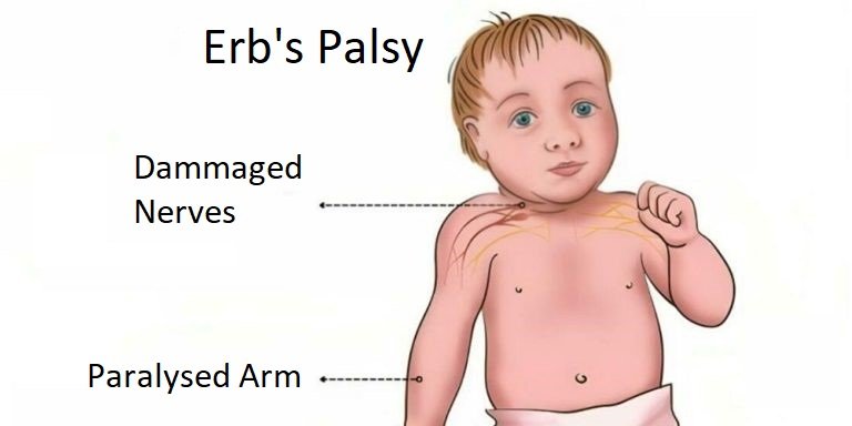 erb's palsy ppt