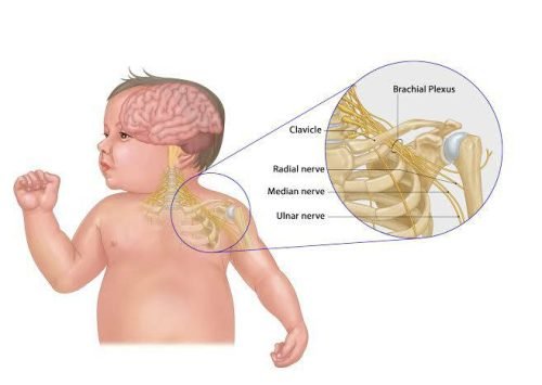 erb's palsy causes